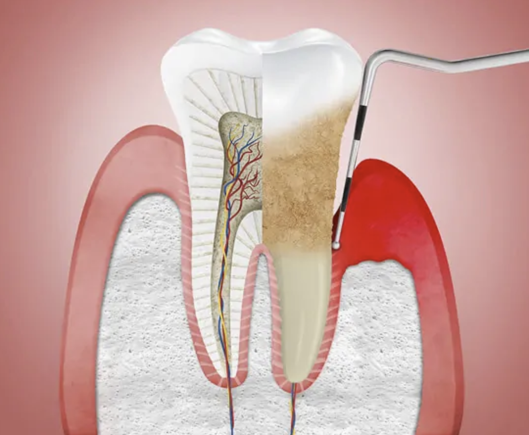 cirugia periodontal
